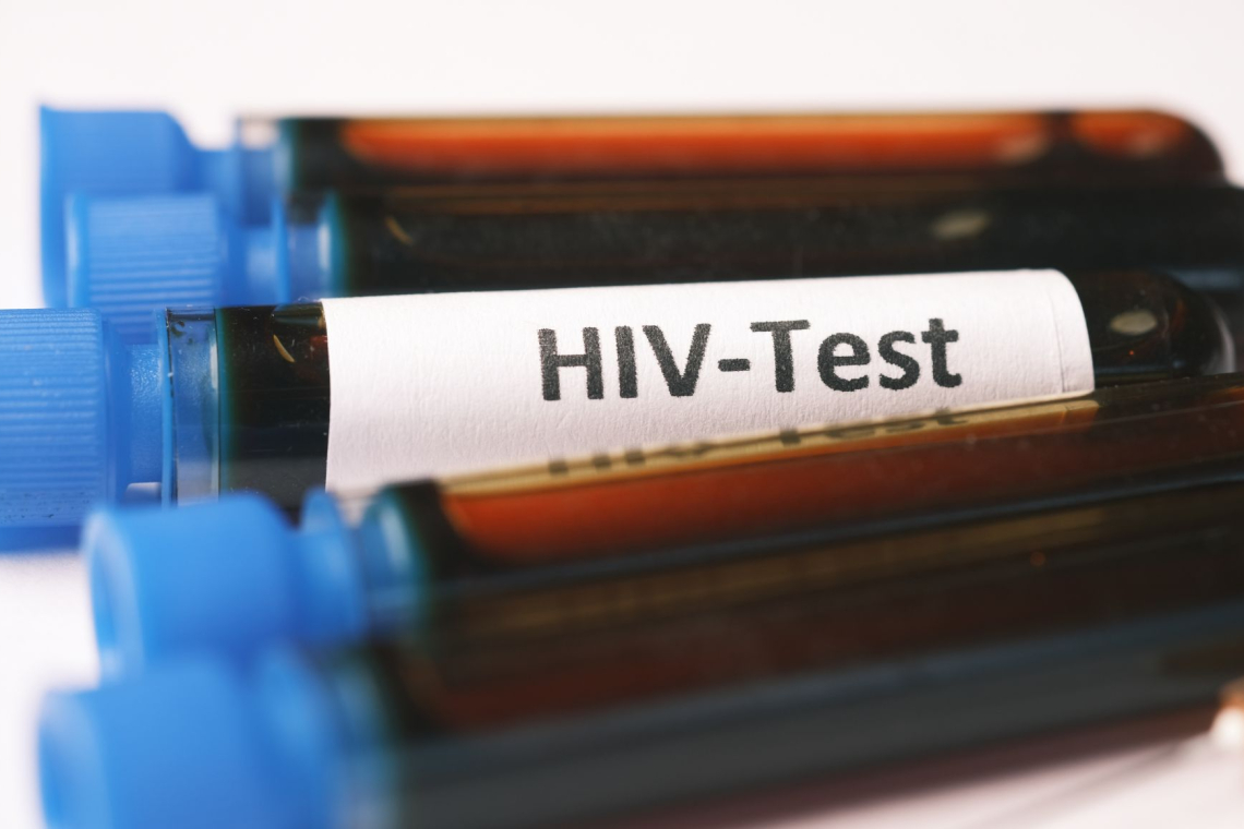 Slovenija ohranja nizko stopnjo epidemije HIV, skrb vzbujajo pozne diagnoze